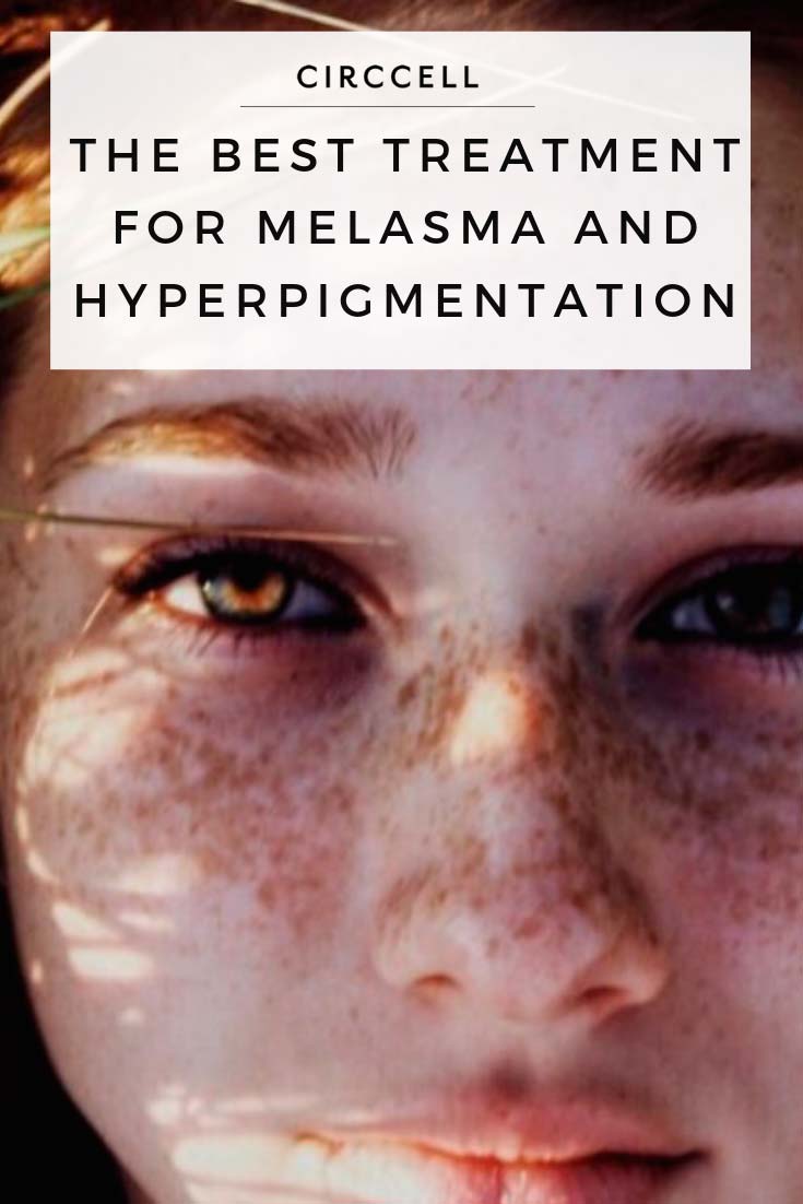 Best Treatment for Melasma and Hyperpigmentation