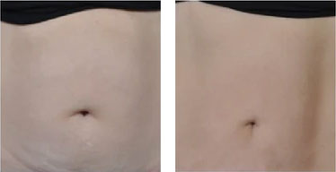 After and before of body contouring