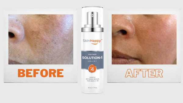 before-and-after-retinoids