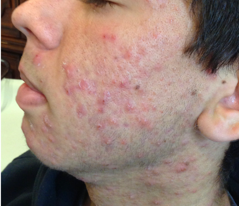 acne-before-3