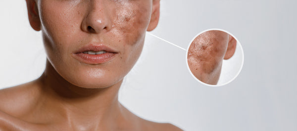 Melasma vs Sun Spots