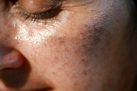 Are sun spots permanent or dangerous?