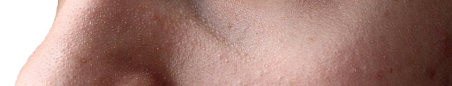 Blackheads and Whiteheads