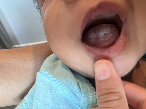 Thrush on babies tongue