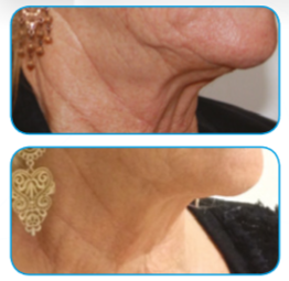 3d lipo face