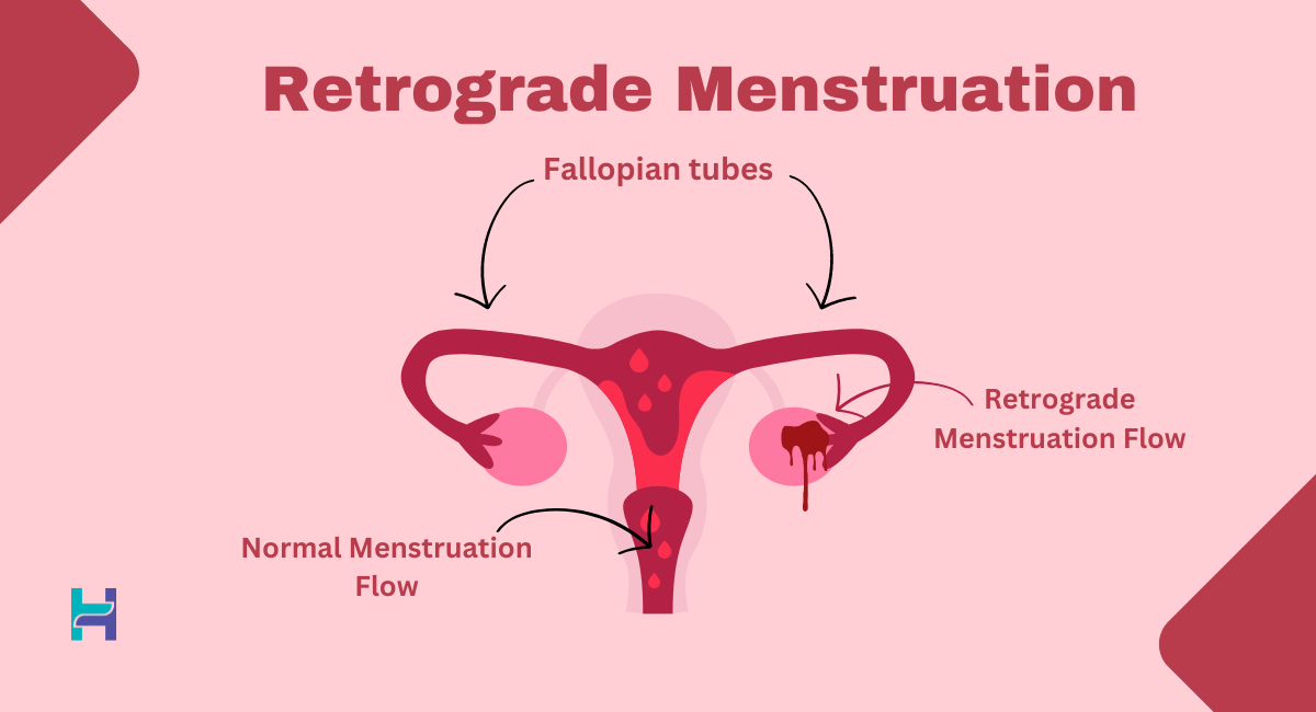 retrograde menstrual flow