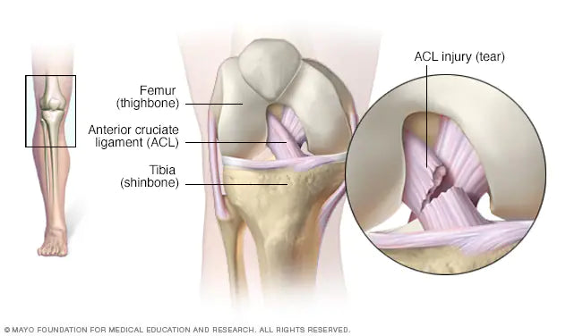 diagram of the ACL courtesy of the Mayo Clinic