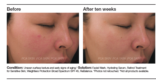 before and after ten weeks sensitive skin retinol serum pca skin available at skinluxe