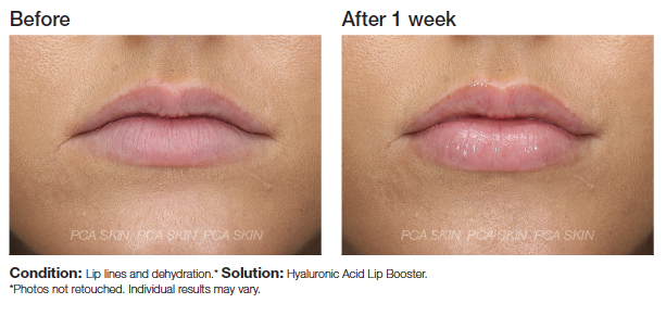 Hyaluronic Acid Lip Booster skinluxe online now