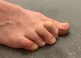 claw toe, footnurse, bent toe, sore toe, corn treatment thunder bay