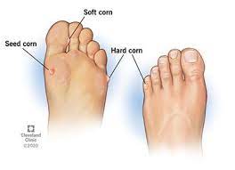 FootNurse, corn treatment, foot corn, sore foot, sore in between toes