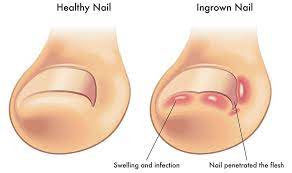 ingrown toenail, ingrown nail treatment thunder bay, footnurse