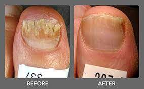 laser Toenail fungus treatment thunder bay, footnurse, toenail fungus before and after