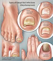 Treating Toenail Fungus