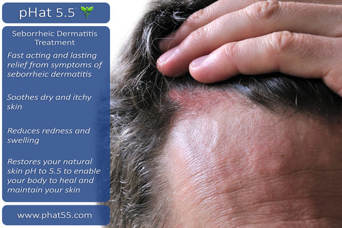 Seborrheic Dermatitis Scalp