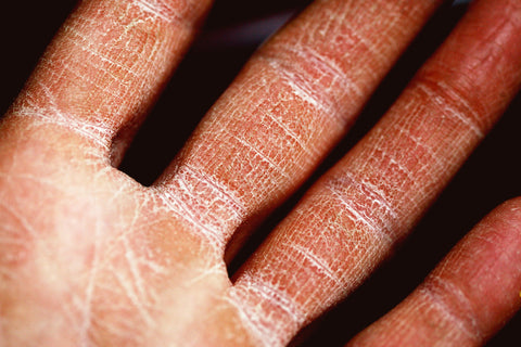 hand with eczema