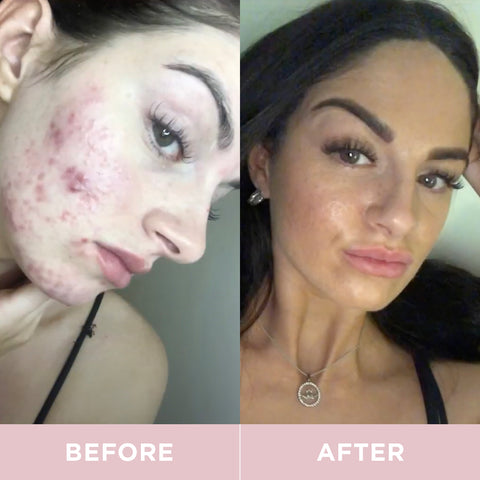 Before and After of Acne