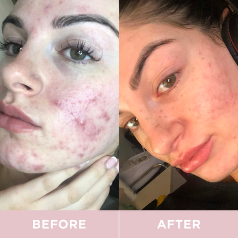 Before and after of Acne