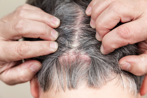 noncomedogenic ingredients acne on scalp, urth