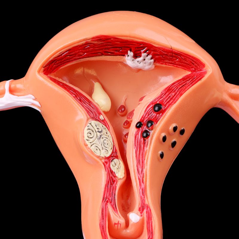 Utero patologico | Coyitosmx