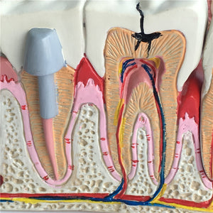 Modelo Anatomico Dental Patología caries odontologia | Coyitosmx