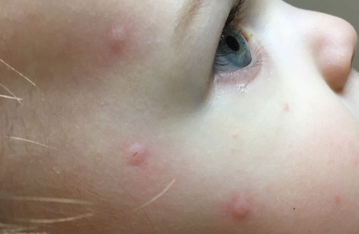 bed bug bites on face and neck