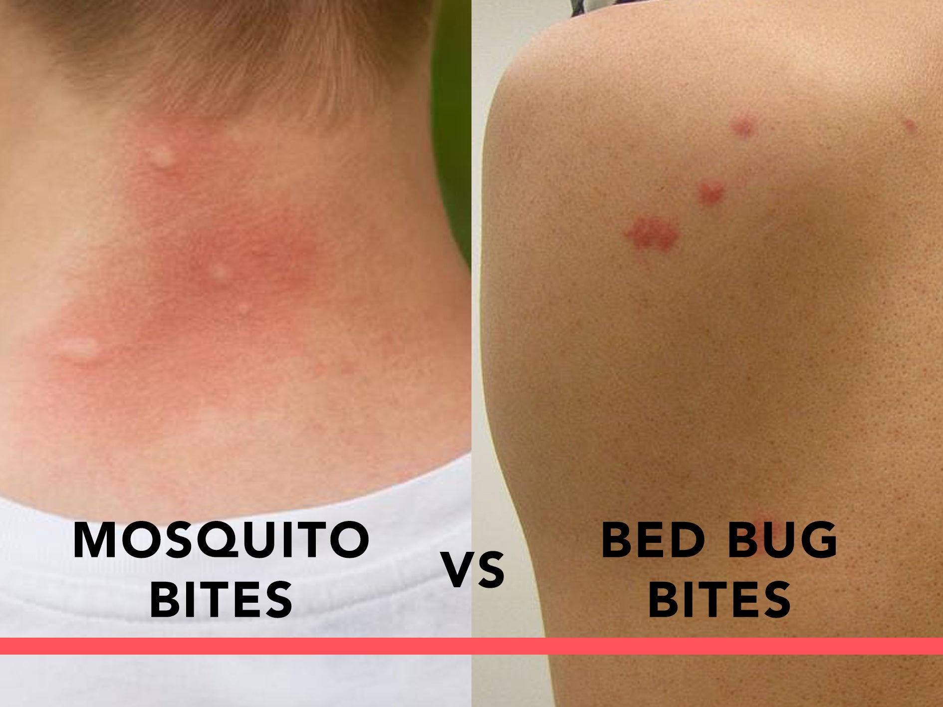 Mosquito Bites Bed Bug Bites