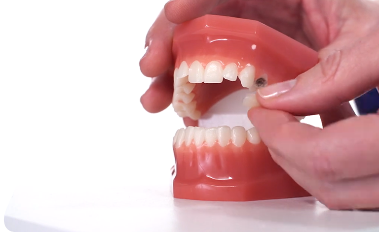 Dioche Dental Tooth Filling Material, Dental Tooth Filling Material  Temporary Stopping for Dental Treatment, Temporary Missing Cracked Broken  Teeth