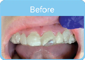 Before Using OrVance® Aligner Pontics