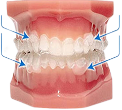 Including clear aligner trays