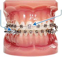 Works on all orthodontic appliances