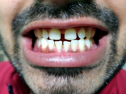 how to reduce gap between teeth naturally