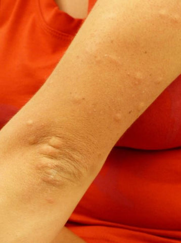 mosquito bites on skin - incognito singapore 