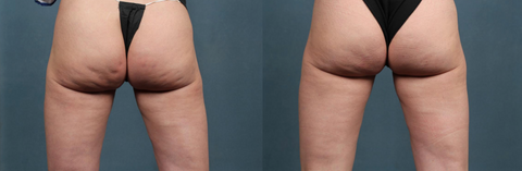 sculptskin cellulite before and after results. reduce cellulite in the butt, legs, arms, and much more. Get rid of cellulite fat easy and fast with the sculptskin body