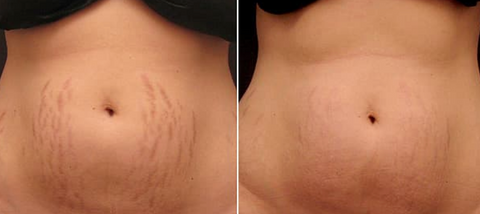 sculptskin stretch marks before and after results. reduce dark and large stretch marks with radio frequency