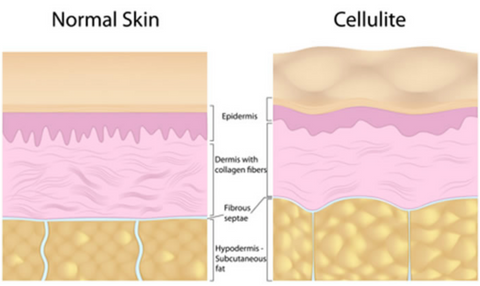 SculptSkin cavitation pro cellulite before and after benefits