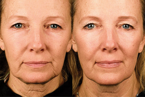 SculptSkin cavitation pro radio frequency, rf, skin before and after results