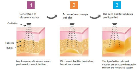 SculptSkin Cavitation pro how does cavitation work and how does cavitation get rid of fat and cellulite in the body