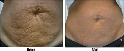 SculptSkin cavitation pro radio frequency results for the body core and stomach results