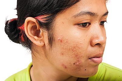 Acne prone skin