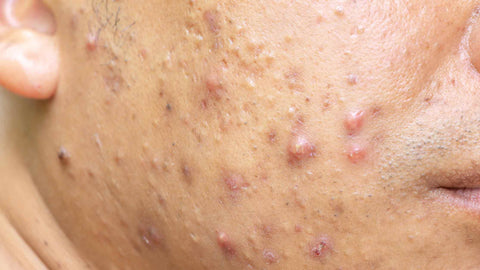 Nodules acne