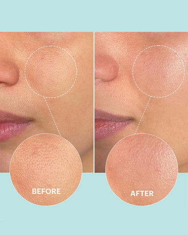 How exfoliating acids refine skin pores