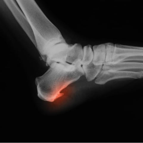 Understanding Heel Spurs: Symptoms, Causes, and Treatments