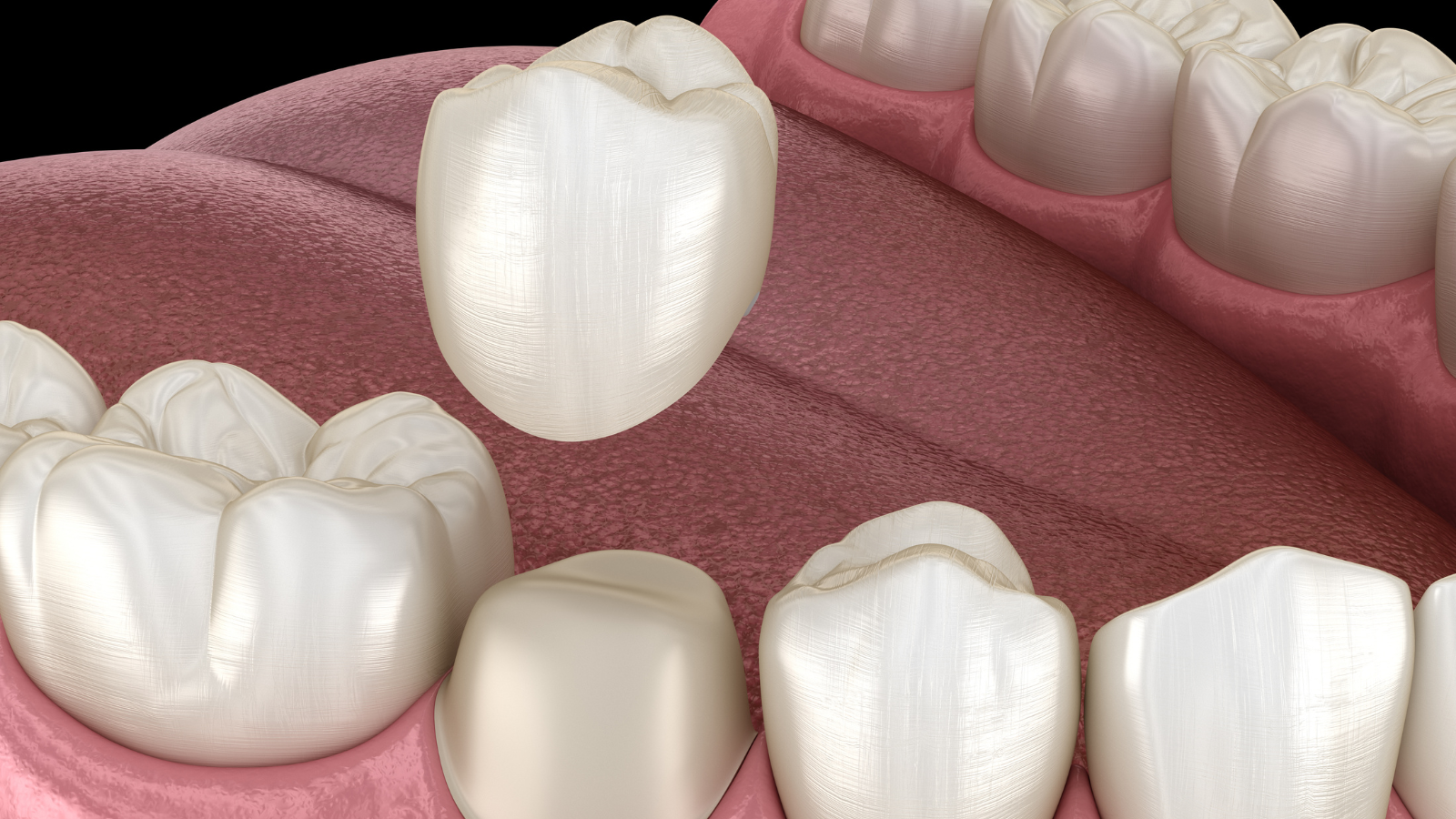 Dental Crowns