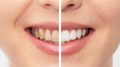 What is Teeth Discoloration