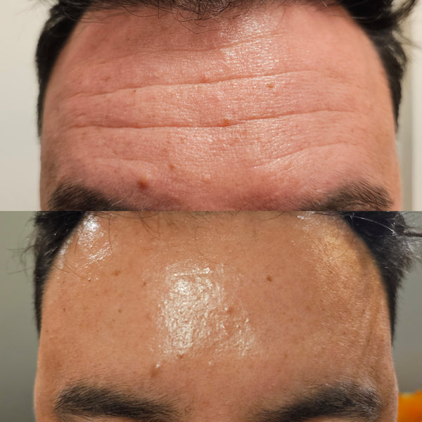Before and after man antiwrinkle treatment