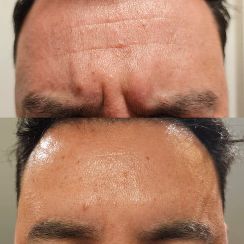 Antiwrinkle treatment for men Frown