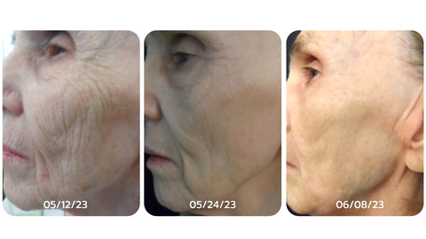 ViFace Lifting Facial Ultrasonique