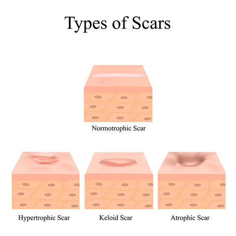 type of scars: hypertrophic scar, keloid scar, atrophic scar and normotrophic scar
