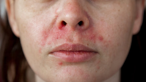 How Can I Reduce My Acne?